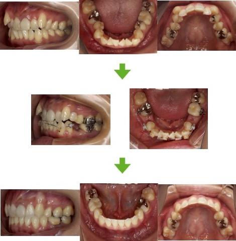 【症例9】叢生症例 30代女性