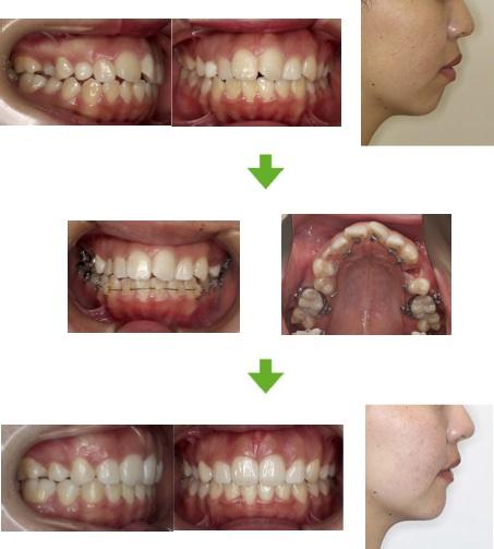 【症例10】右上3番欠損開咬症例 10代女性