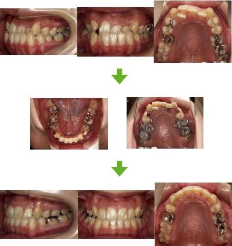 【症例11】重度の叢生を伴う反対咬合症例　20代女性