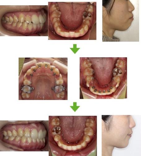 【症例13】上下顎前突症例　30代女性