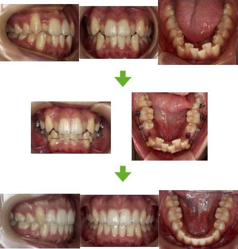 【症例12】長期安定している叢生症例　20代女性