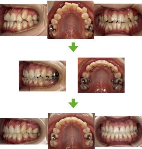 【症例14】開咬と叢生を伴う骨格性反対咬合　10代女性