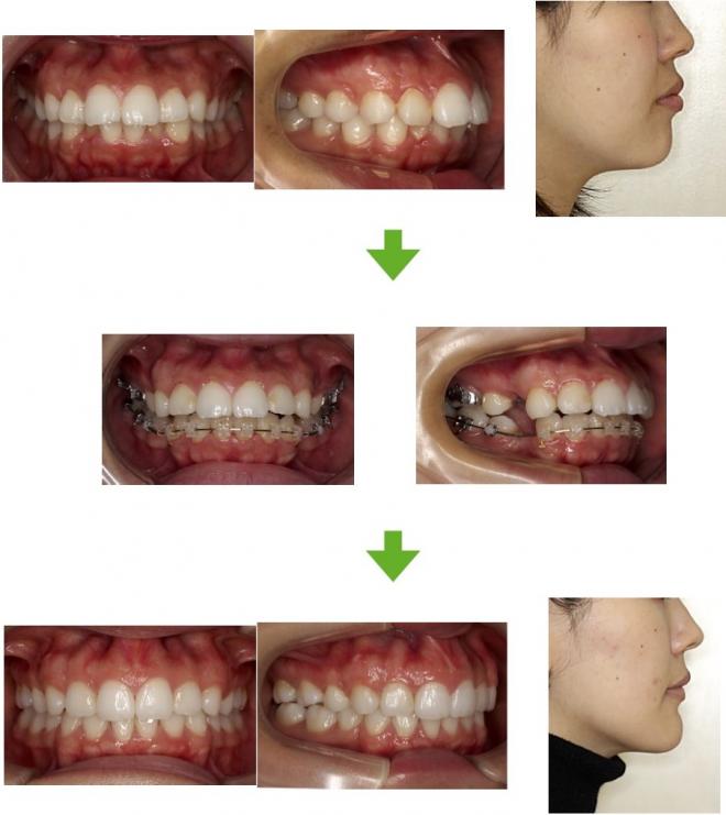 【症例15】上顎前突症例 20代女性