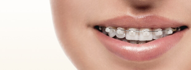 歯列矯正と装置について