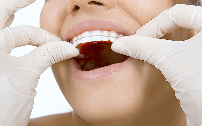 矯正歯科に伴う治療