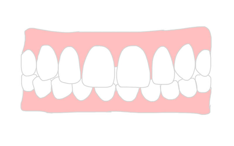 歯の隙間が空いている、すきっ歯
