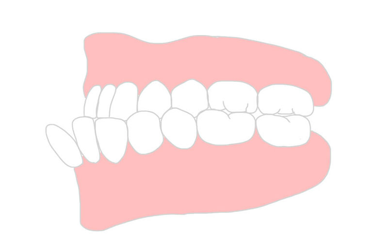 下の前歯が前に出ている